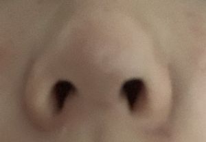 Xuất hiện đốm trắng, cứng nhọn trên đầu mũi