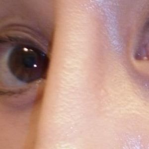 Bao lâu sau nâng mũi thì silicone sẽ làm mỏng da, gây lộ sóng?