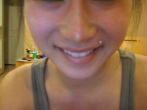 Nhìn rõ sụn nâng mũi qua da sau phẫu thuật