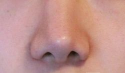 Da chóp mũi trở nên rất mỏng sau 5 năm ghép sụn. Liệu da có tiếp tục mỏng đi không?