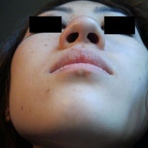 Mũi “củ hành” của tôi có thể chỉnh sửa được bằng phương pháp mổ kín không?