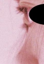 Nâng mũi ở người có mắt lồi