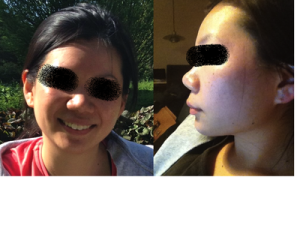 Chỉnh sửa mũi thấp, hếch với trụ mũi co rút, da mũi dày