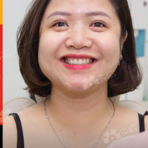Hình ảnh dán sứ Veneer – Nha khoa TMQT Delia – Ca 10