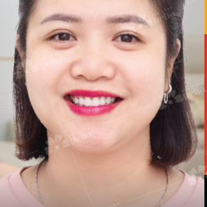 Hình ảnh dán sứ Veneer – Nha khoa TMQT Delia – Ca 10