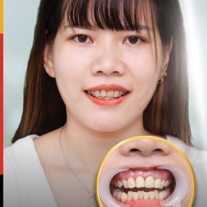 Hình ảnh bọc răng sứ của KH Linh Nhi – Nha khoa TMQT Delia – Ca 11