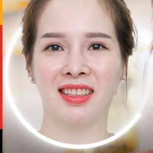 Hình ảnh dán sứ Veneer – Nha khoa TMQT Delia – Ca 12