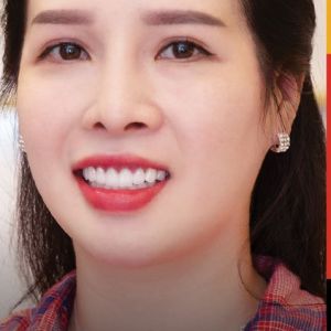 Hình ảnh dán sứ Veneer – Nha khoa TMQT Delia – Ca 12