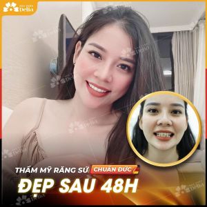 Hình ảnh bọc răng sứ của KH Đặng Phương Mai – Nha khoa TMQT Delia – Ca 13