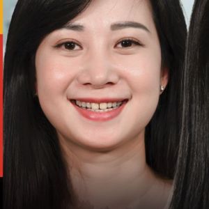 Hình ảnh bọc răng sứ của KH Lê Dung – Nha khoa TMQT Delia – Ca 15