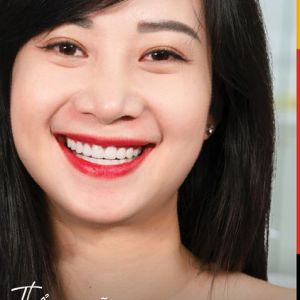 Hình ảnh bọc răng sứ của KH Lê Dung – Nha khoa TMQT Delia – Ca 15