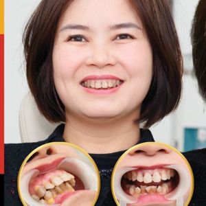 Hình ảnh bọc răng sứ của KH Phạm Vui – Nha khoa TMQT Delia – Ca 16