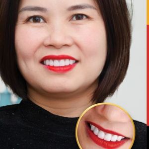 Hình ảnh bọc răng sứ của KH Phạm Vui – Nha khoa TMQT Delia – Ca 16