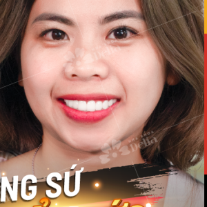 Hình ảnh bọc răng sứ - Nha khoa TMQT Delia – Ca 4