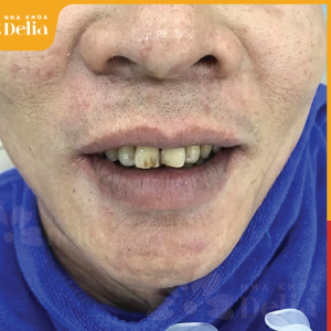 Hình ảnh bọc răng sứ của KH Nguyễn Duy – Nha khoa TMQT Delia – Ca 6