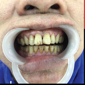 Hình ảnh bọc răng sứ của KH Nguyễn Duy – Nha khoa TMQT Delia – Ca 6