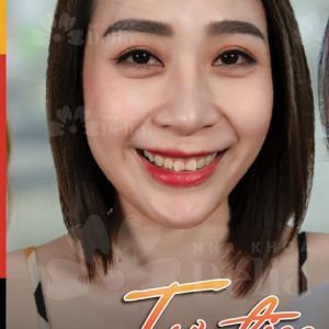 Hình ảnh dán sứ của KH Minh Thu – Nha khoa TMQT Delia – Ca 7