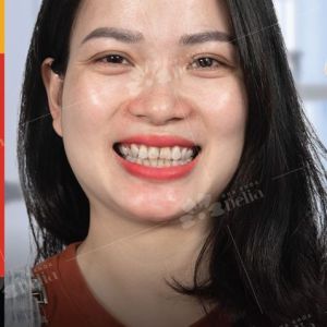 Hình ảnh bọc răng sứ của KH Trà My – Nha khoa TMQT Delia – Ca 9