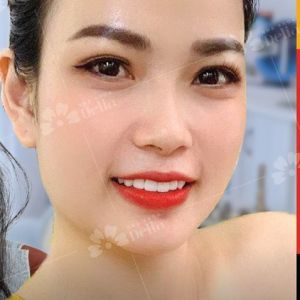 Hình ảnh bọc răng sứ của KH Trà My – Nha khoa TMQT Delia – Ca 9