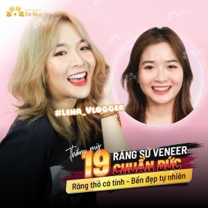 Hình ảnh dán sứ Veneer của KH Lena – Nha khoa TMQT Delia – Ca 1