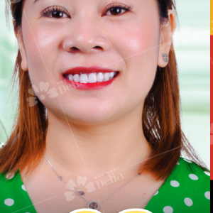 Hình ảnh bọc răng sứ của KH Bế Thu Thủy – Nha khoa TMQT Delia – Ca 2
