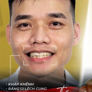 Hình ảnh bọc răng sứ của KH Trần Thiệu – Nha khoa TMQT Delia – Ca 3