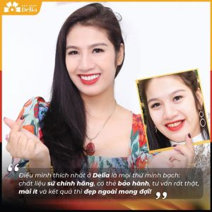 Hình ảnh dán sứ Veneer của KH Nguyễn Hà – Nha khoa TMQT Delia – Ca 5