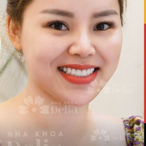 Hình ảnh dán sứ - Nha khoa TMQT Delia – Ca 8