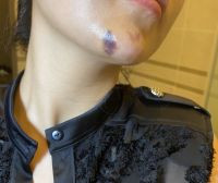 Tiêm filler cằm bầm tím