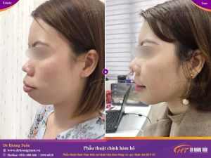 Hình ảnh phẫu thuật hàm – Dr Hoàng Tuấn – Ca 10