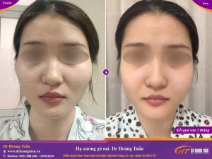 Hình ảnh hạ gò má – Dr Hoàng Tuấn – Ca 11
