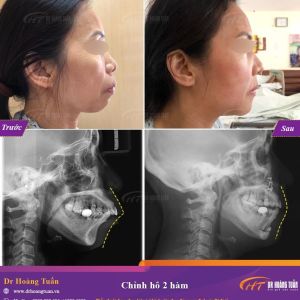Hình ảnh phẫu thuật hàm – Dr Hoàng Tuấn – Ca 12