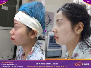 Hình ảnh phẫu thuật hàm – Dr Hoàng Tuấn – Ca 13