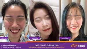 Hình ảnh phẫu thuật hàm – Dr Hoàng Tuấn – Ca 15