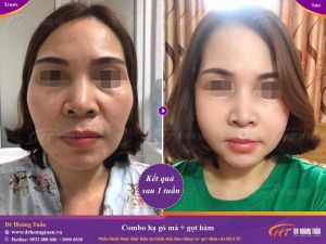 Hình ảnh phẫu thuật hàm – Dr Hoàng Tuấn – Ca 16