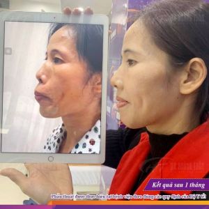 Hình ảnh phẫu thuật hàm – Dr Hoàng Tuấn – Ca 2