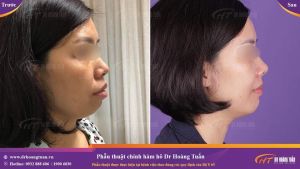 Hình ảnh phẫu thuật hàm – Dr Hoàng Tuấn – Ca 4