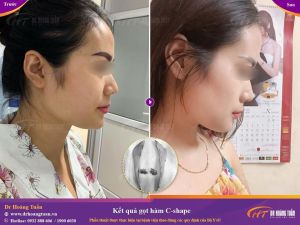 Hình ảnh phẫu thuật gọt hàm – Dr Hoàng Tuấn – Ca 5