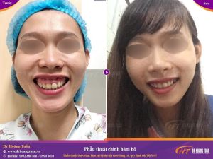 Hình ảnh phẫu thuật hàm – Dr Hoàng Tuấn – Ca 6