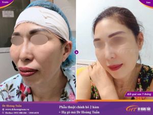 Hình ảnh phẫu thuật hàm và hạ gò má – Dr Hoàng Tuấn – Ca 7