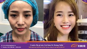 Hình ảnh gọt hàm kết hợp hạ gò má – Dr Hoàng Tuấn – Ca 9