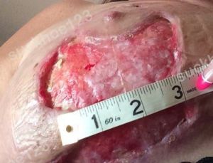 Hoại tử da sau treo ngực sa trễ, liệu da có tự liền lại được không?