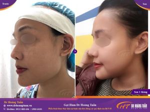 Hình ảnh gọt hàm – Dr Hoàng Tuấn – Ca 14