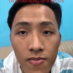 Hình ảnh phẫu thuật hàm – Viện Thẩm mỹ Hùng Vương – Ca 10