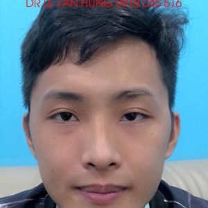 Hình ảnh phẫu thuật hàm – Viện Thẩm mỹ Hùng Vương – Ca 10