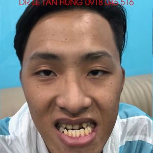 Hình ảnh phẫu thuật hàm – Viện Thẩm mỹ Hùng Vương – Ca 10