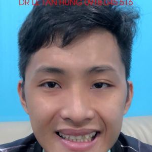 Hình ảnh phẫu thuật hàm – Viện Thẩm mỹ Hùng Vương – Ca 10