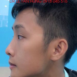 Hình ảnh phẫu thuật hàm – Viện Thẩm mỹ Hùng Vương – Ca 10