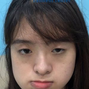 Hình ảnh phẫu thuật hàm - Viện Thẩm mỹ Hùng Vương – Ca 11