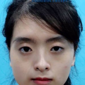 Hình ảnh phẫu thuật hàm - Viện Thẩm mỹ Hùng Vương – Ca 11